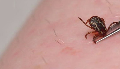 Learning to live with Lyme Disease